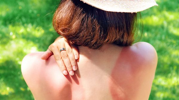 Pelle arrossata: perché compare e come aiutare la barriera cutanea a ritrovare il suo equilibrio